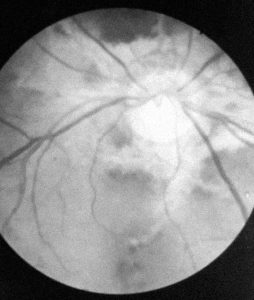 As a medical resident, the author sees angioid streaks that identify a connective tissue disease in the eye of his patient.